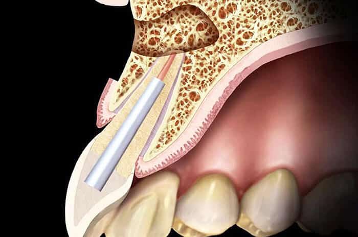 Cross-section dental anatomy illustration showing tooth, bone structure, and gum tissue detail.