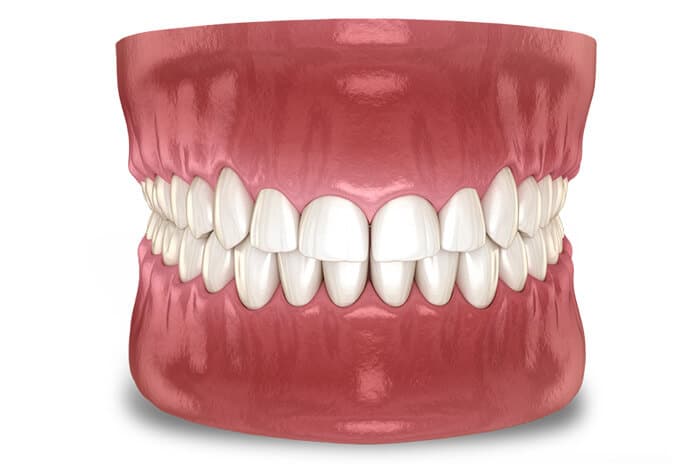 Anatomical dental model displaying upper and lower teeth with pink gums and white teeth.
