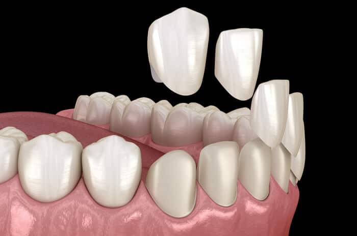 3D dental implant illustration showing tooth restoration with prosthetic crowns on gum model
