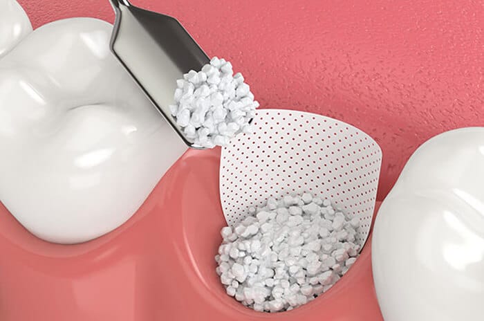 White dental aligners filled with composite material beads against pink background.