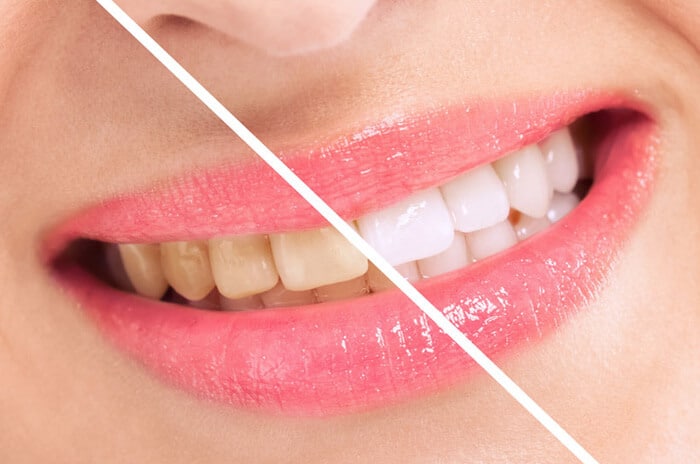 Before and after comparison of teeth whitening results showing yellowed teeth transforming to bright white teeth.
