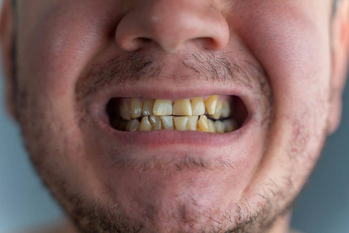 What Are the Options for Bad Teeth?