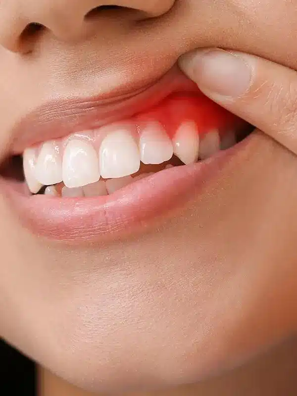 Close-up of person's mouth showing red inflamed gum area near teeth, indicating gum disease or irritation.